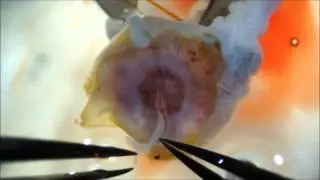 Splitting of the umbilical cord