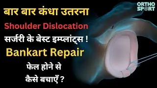 कंधा उतरना Shoulder Dislocation सर्जरी के बेस्ट इम्प्लांट्स, Bankart Repair फेल होने से कैसे बचाएँ ?