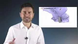 New Zygomatic Implant (private) English