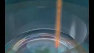IntraLase SBK All Laser LASIK