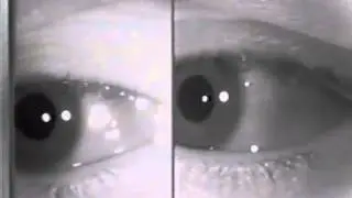 Physiologic (End-Gaze) Nystagmus [ARCHIVE]