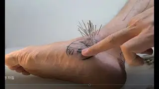 발목 삐어서 한의원 가면? 발목 통증의 설명+ 침치료 방법