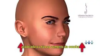 OTOPLASTIA - Dra. Débora Tomatis Pacheco - Cirurgia Plástica - Porto Alegre/RS