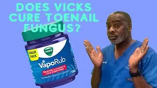 Does Vicks Cure Toenail Fungus?