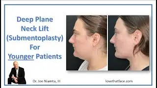 Deep Plane Neck Lift (Submentoplasty) for Younger Patients