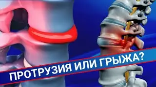 ПРОТРУЗИЯ ИЛИ ГРЫЖА: 5 основных отличий