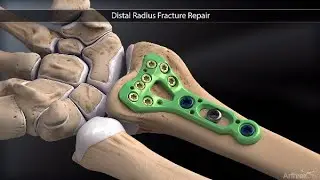 Distal Radius Fracture Repair