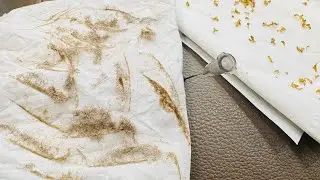 Removal big black heads