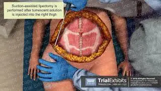 Liposuction of Outer Thigh