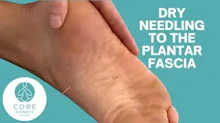 Dry Needling  to the Plantar Fascia
