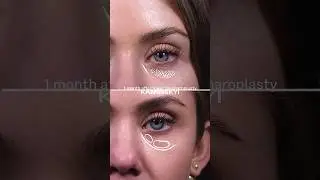 “Puffy eyes” ✨ before and after results. #puffyeyes #blepharoplasty #kaminskyi