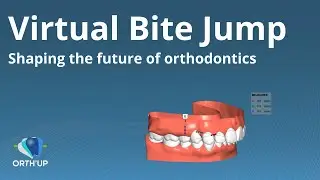 Virtual Bite Jump | ORTH'UP Clear Aligners Software for Orthodontists