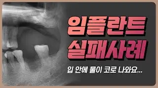 임플란트는 심고 난 이후 관리가 가장 중요합니다. #임플란트