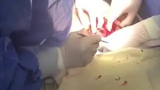 Экстренное кесарево
