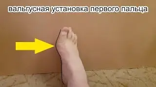 Перегрузка стопы и вред упражнений от плоскостопия