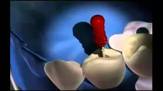 Rubber Dam - Miskin Ajax Dental