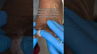 Interdigital tinea pedis 