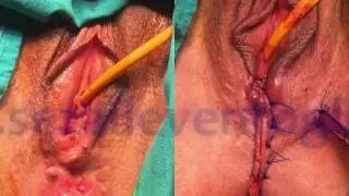 Prof. Dr. Sezai Leventoğlu-Overlapping sfinkter onarımı