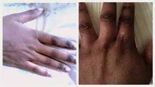 🎀 L'eczéma des mains, mon expérience