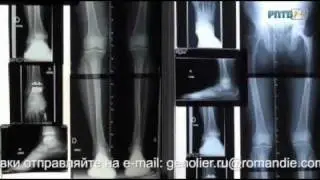 Лечение суставов. Швейцарская Клиника