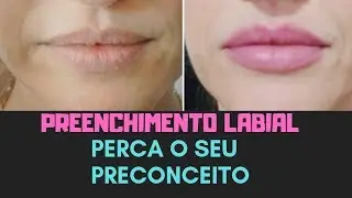 PREENCHIMENTO LABIAL PERCA O SEU PRECONCEITO