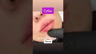 Увеличение губ. До/после.