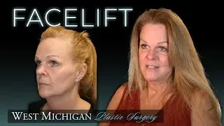 FACELIFT? Before and After Photos - Recovery Secrets - Day Of Surgery