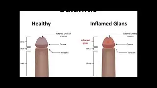 Causas de balanitis