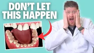 How To Stop Grinding and Clenching Your Teeth (Bruxism)