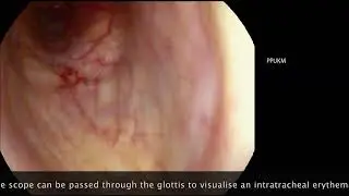 Laryngeal Gargle