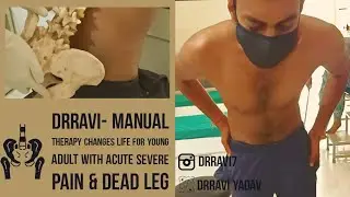 DrRavi- Manual Therapy Changes Life For Young Adult With Acute Severe Pain & Dead Leg