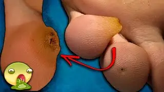 6th FINGER! 😱 what is hiding under the skin ?! Wart. Core corn. How to remove corns? MASSIVE CORN