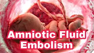 Amniotic Fluid Embolism Nursing|Causes|Symptoms, Treatment|Complications