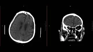 Neuroradiology Call Prep Cases: Acute Subdural Hematoma (CT) Case 7 Discussion