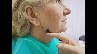 Можно ли ставить пиявок на сосудистые сеточки на лице?