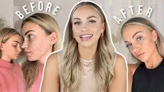 HOW I CLEARED MY SKIN! ✨ MY TOP 8 SKINCARE TIPS || AM + PM Skincare Routine