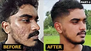 എത്ര കടുപ്പമുള്ള മുഖകുരുവും മാറ്റാം! Isotretinoin 20 mg Capsule🔥 Review (Part-2)