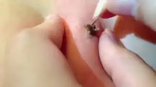 10ти летний прыщ 18 +