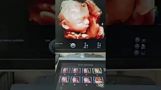 56 || Fetal Face 3D in Pregnancy Ultrasound
