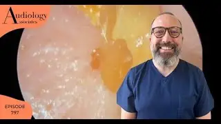 4 X EAR WAX REMOVALS - EP797