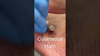 Cutaneous horn watch the removal on my channel! 