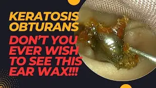Keratosis Obturans - Ear Wax That You Never Wish To See In Your Clinic!