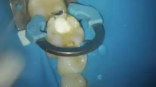 Aplicação de Clorexidine