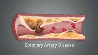 What causes a heart attack