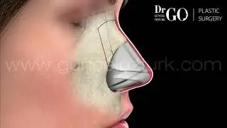 Koruyucu Burun Estetiği (Let Down & Push Down) Ameliyatı Nasıl Yapılır? Op. Dr. Güncel Öztürk 