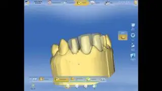 Carillas de Porcelana Veneers CEREC