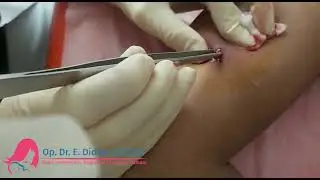 Doğum Kontrol İmplantı Çıkarılışı (Koldan) | Op. Dr. E. Didem ULUSOY