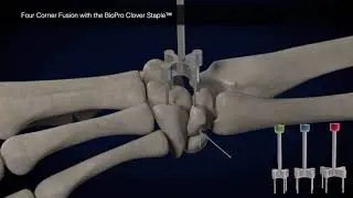 Four Corner Fusion with the BioPro Clover Staple