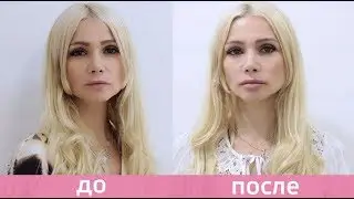 Контурная пластика губ