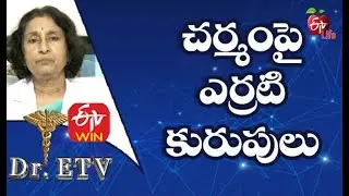 Cherry Angioma  | చర్మం పై ఎర్రటి కురుపులు | Dr.ETV | 18th January 2021 | ETV Life